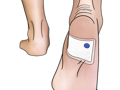 This Plastic Dot Sniffs Out Infections Doctors Can’t&nbsp;See